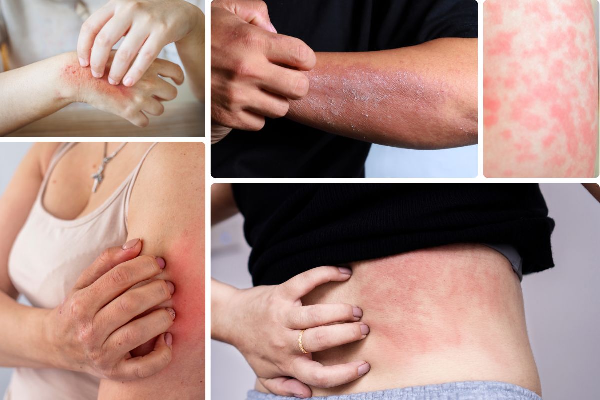 Tình trạng nước nhiễm khuẩn gây ra nhiều vấn đề về da