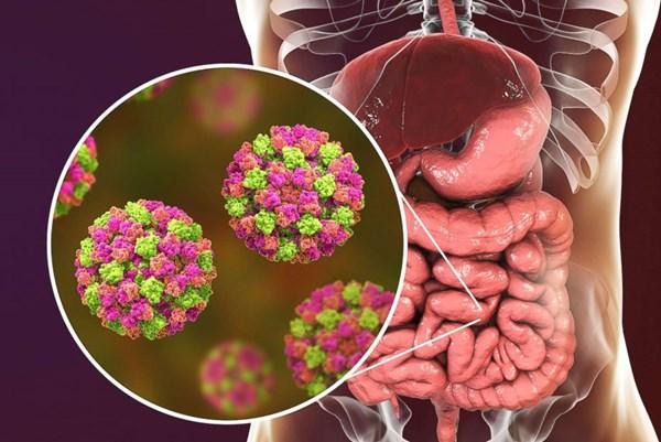 Virus trong nước: Hiểm họa vô hình đe dọa sức khỏe cộng đồng 8 viem-da-day-ruot-do-norovirus-gay-ra